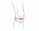 Targeted Tendon Support